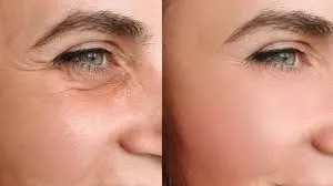 Ácido hialurónico en ojeras: el ajuste que devuelve ritmo a tu mirada